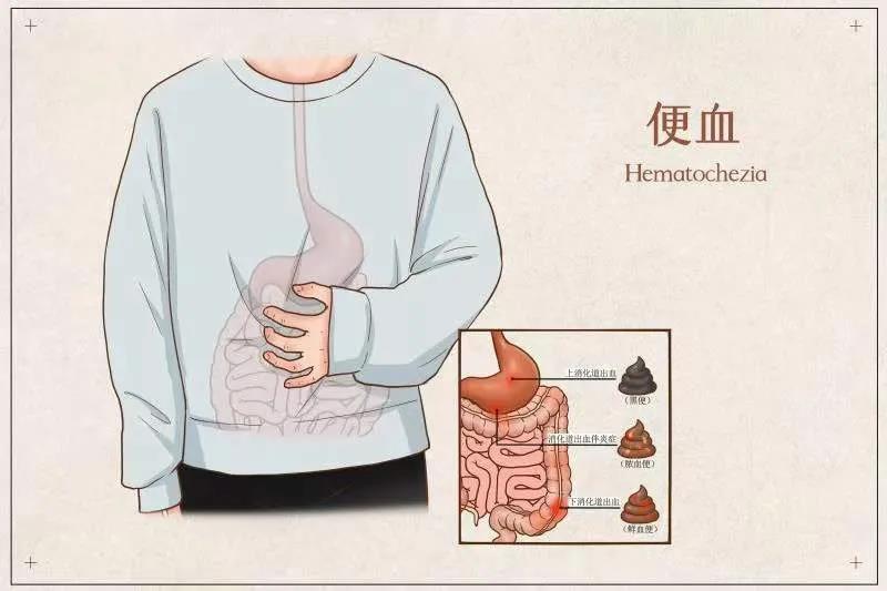 山西肛泰肛肠医院：大便带血需要做哪些检查？